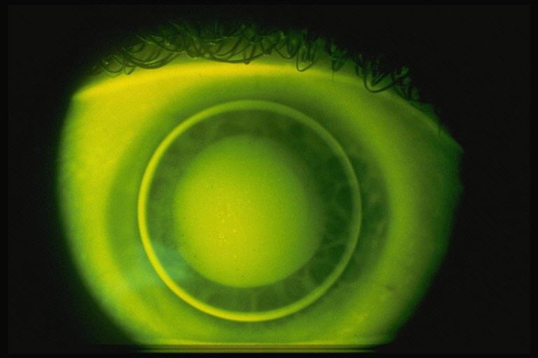 GP and PMMA Contact Lenses Bausch + Lomb